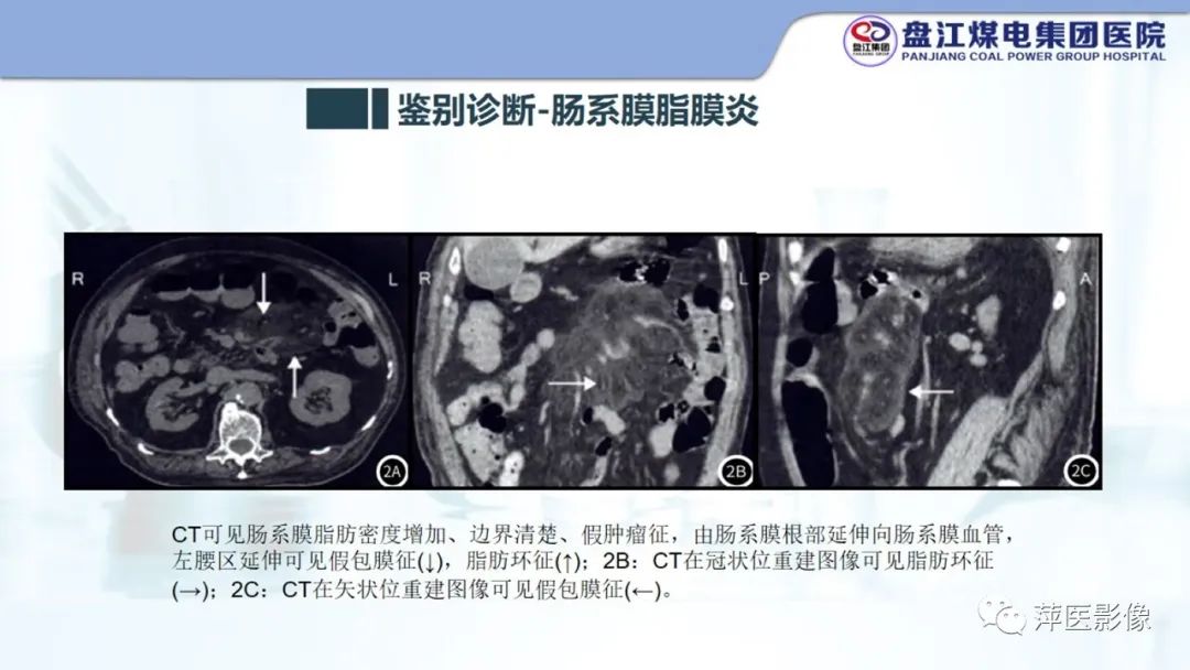 影像PPT - 【PPT】急性肠脂垂炎的CT诊断及鉴别诊断-27