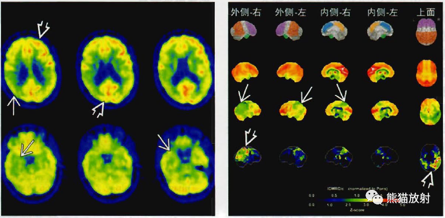 影像PPT - 阿尔茨海默病、帕金森病影像诊断要点-4 影像PPT - 阿尔茨海默病、帕金森病影像诊断要点-4
