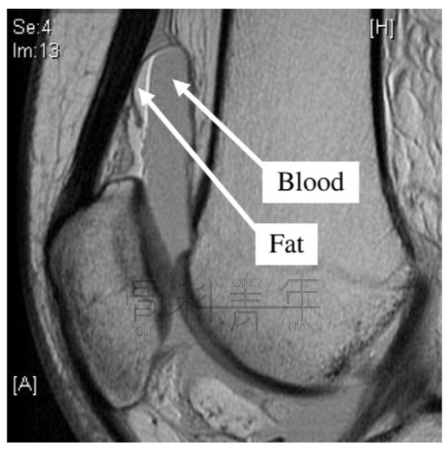 影像PPT - 关节积脂血症(lipohemarthrosis)-2