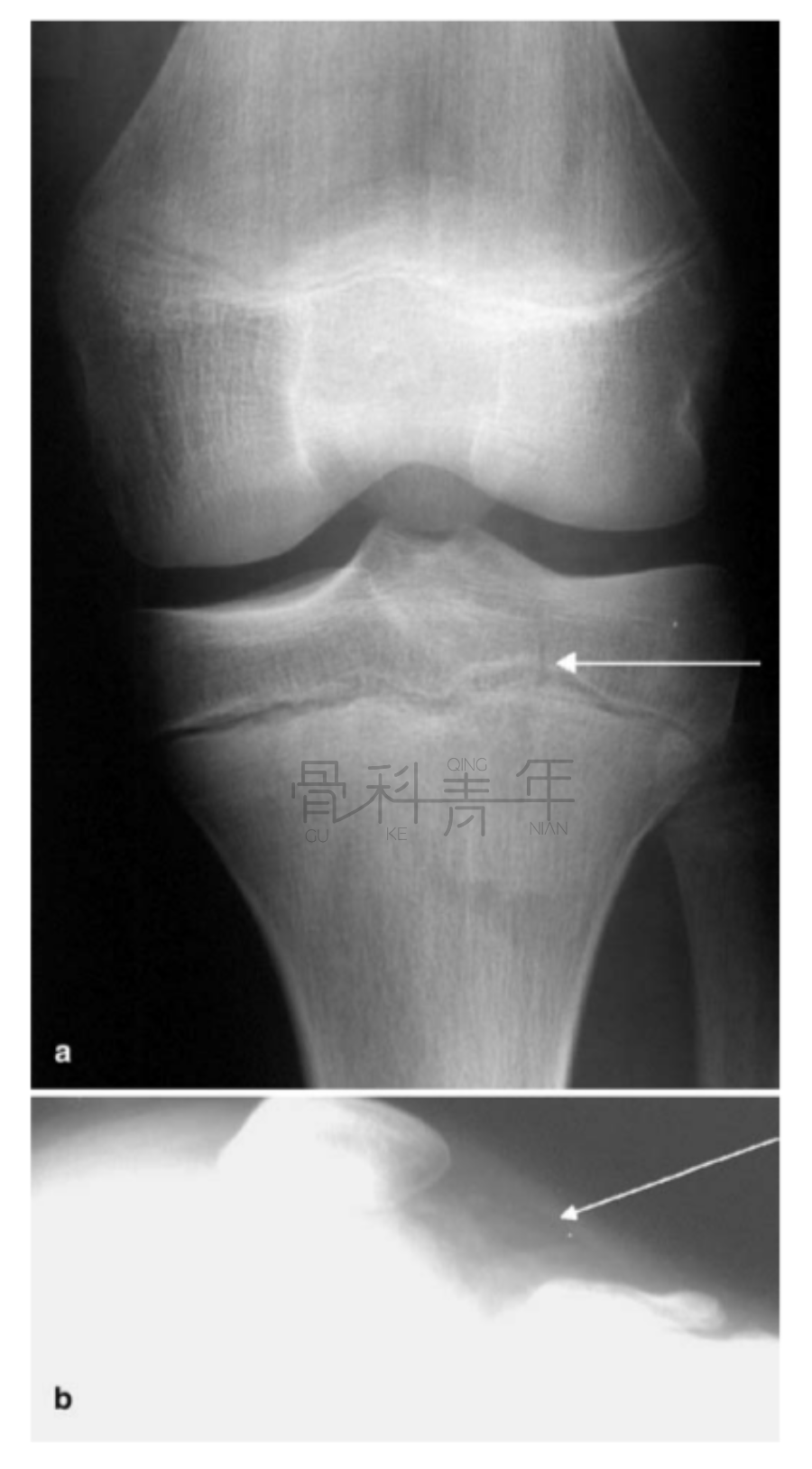 影像PPT - 关节积脂血症(lipohemarthrosis)-3