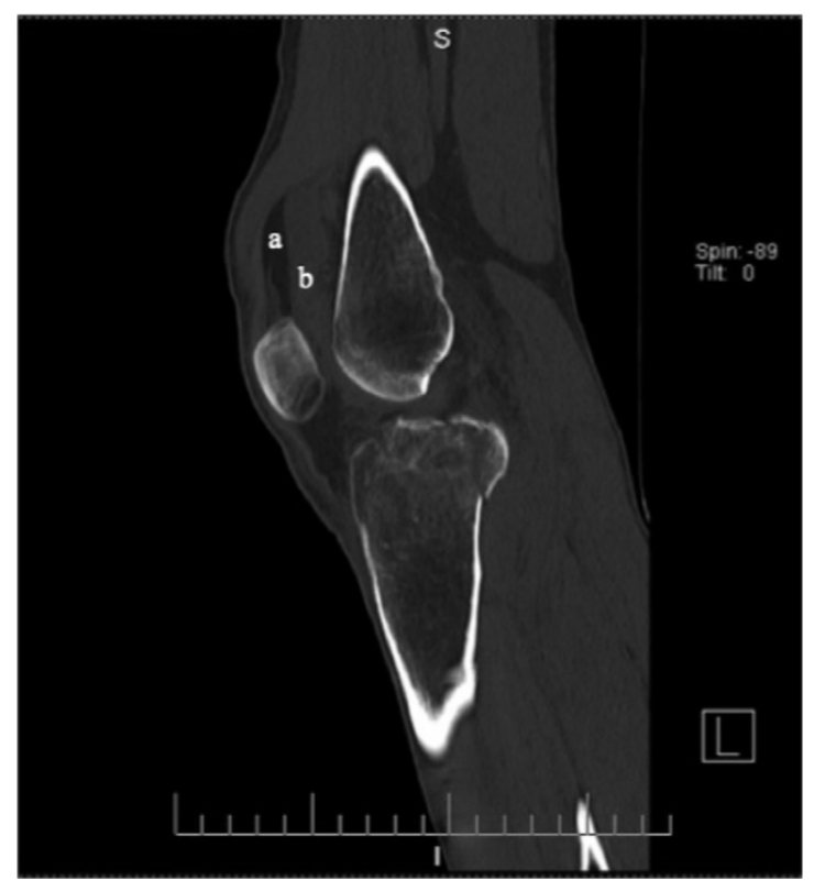 影像PPT - 关节积脂血症(lipohemarthrosis)-7