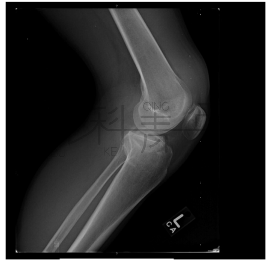 影像PPT - 关节积脂血症(lipohemarthrosis)-5