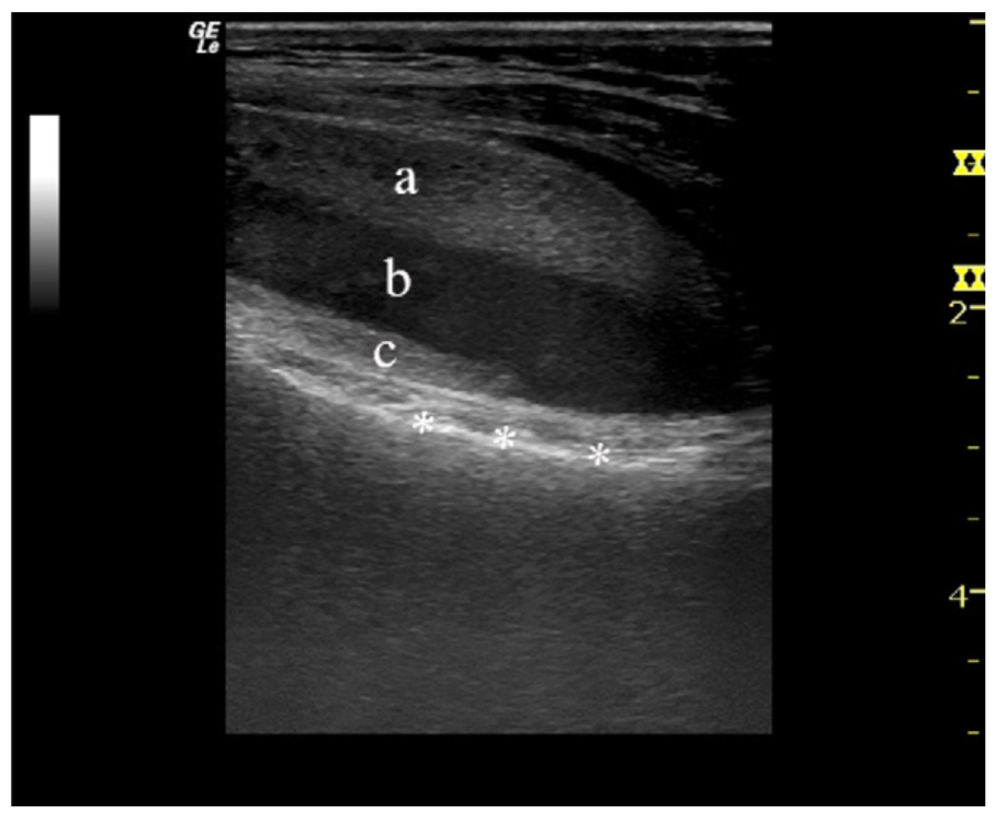 影像PPT - 关节积脂血症(lipohemarthrosis)-6