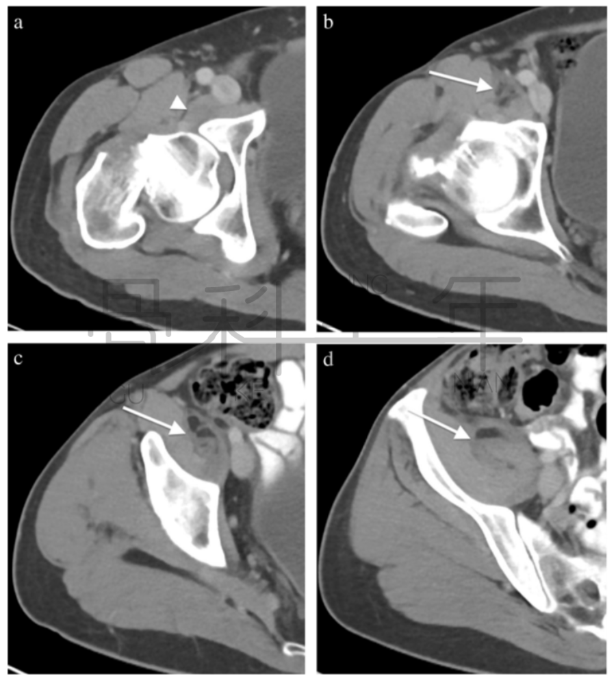 影像PPT - 关节积脂血症(lipohemarthrosis)-9