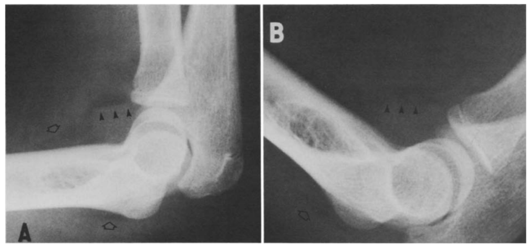 影像PPT - 关节积脂血症(lipohemarthrosis)-11