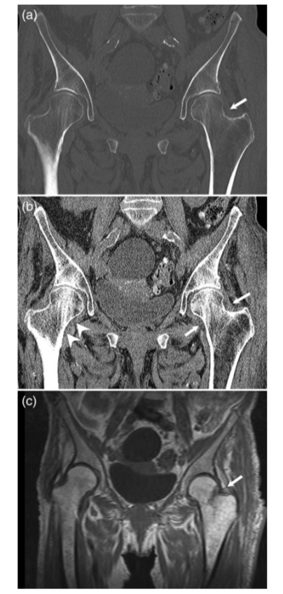 影像PPT - 关节积脂血症(lipohemarthrosis)-10