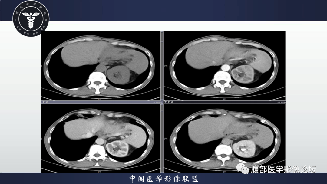 影像PPT - 【病例】腹腔低度恶性肌纤维母细胞肉瘤（LGMS）1例CT-3