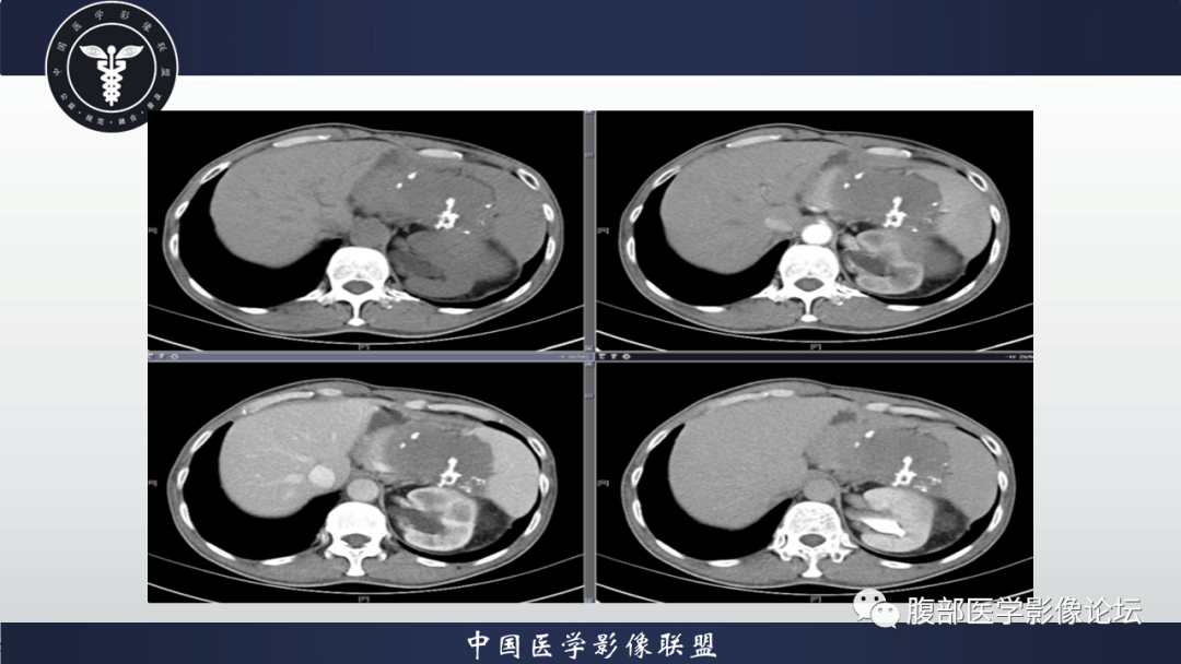 影像PPT - 【病例】腹腔低度恶性肌纤维母细胞肉瘤（LGMS）1例CT-5