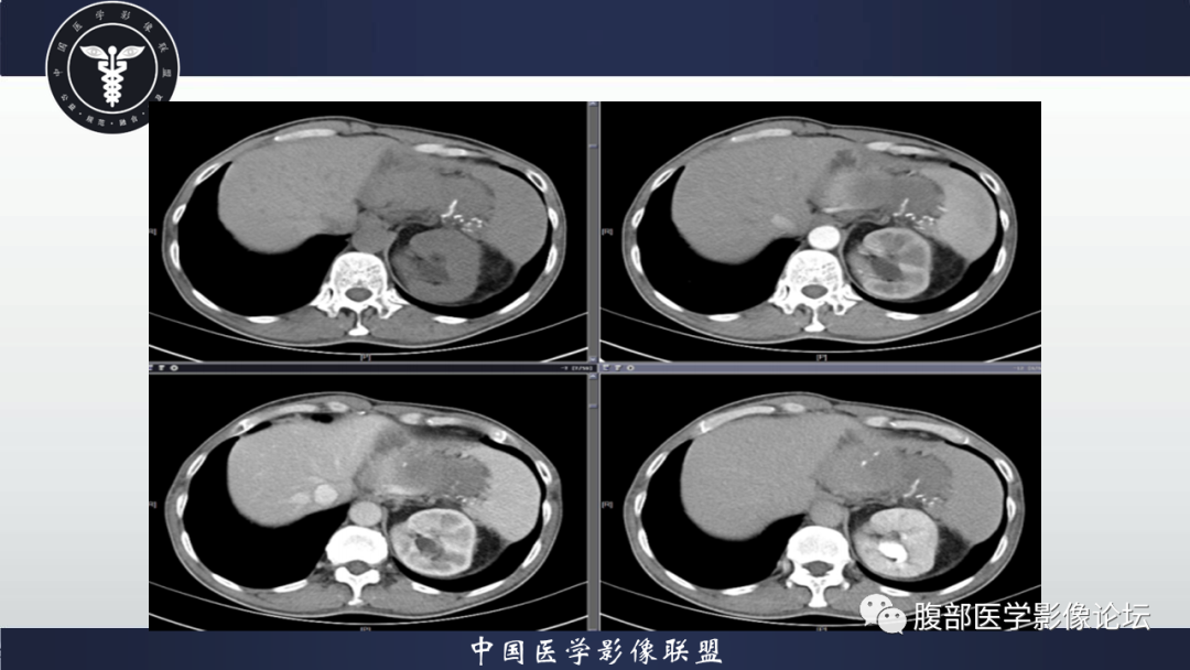影像PPT - 【病例】腹腔低度恶性肌纤维母细胞肉瘤（LGMS）1例CT-4