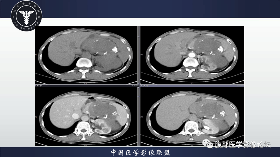 影像PPT - 【病例】腹腔低度恶性肌纤维母细胞肉瘤（LGMS）1例CT-6