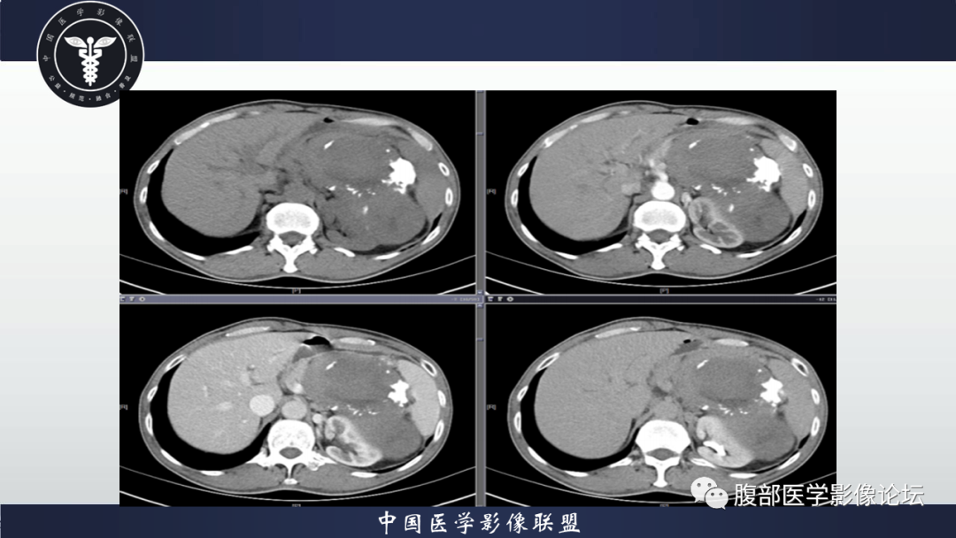 影像PPT - 【病例】腹腔低度恶性肌纤维母细胞肉瘤（LGMS）1例CT-7