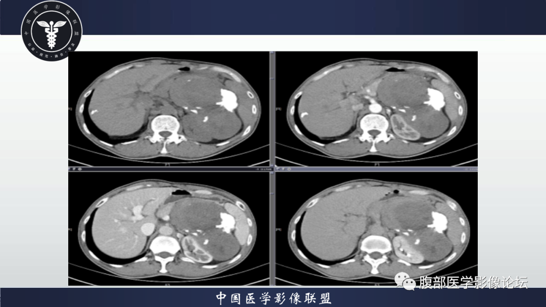 影像PPT - 【病例】腹腔低度恶性肌纤维母细胞肉瘤（LGMS）1例CT-8