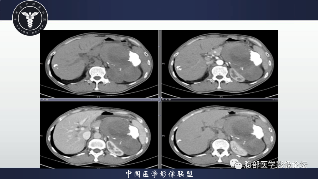 影像PPT - 【病例】腹腔低度恶性肌纤维母细胞肉瘤（LGMS）1例CT-9