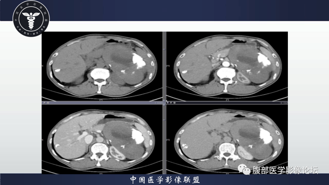 影像PPT - 【病例】腹腔低度恶性肌纤维母细胞肉瘤（LGMS）1例CT-10