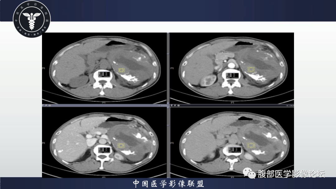 影像PPT - 【病例】腹腔低度恶性肌纤维母细胞肉瘤（LGMS）1例CT-11