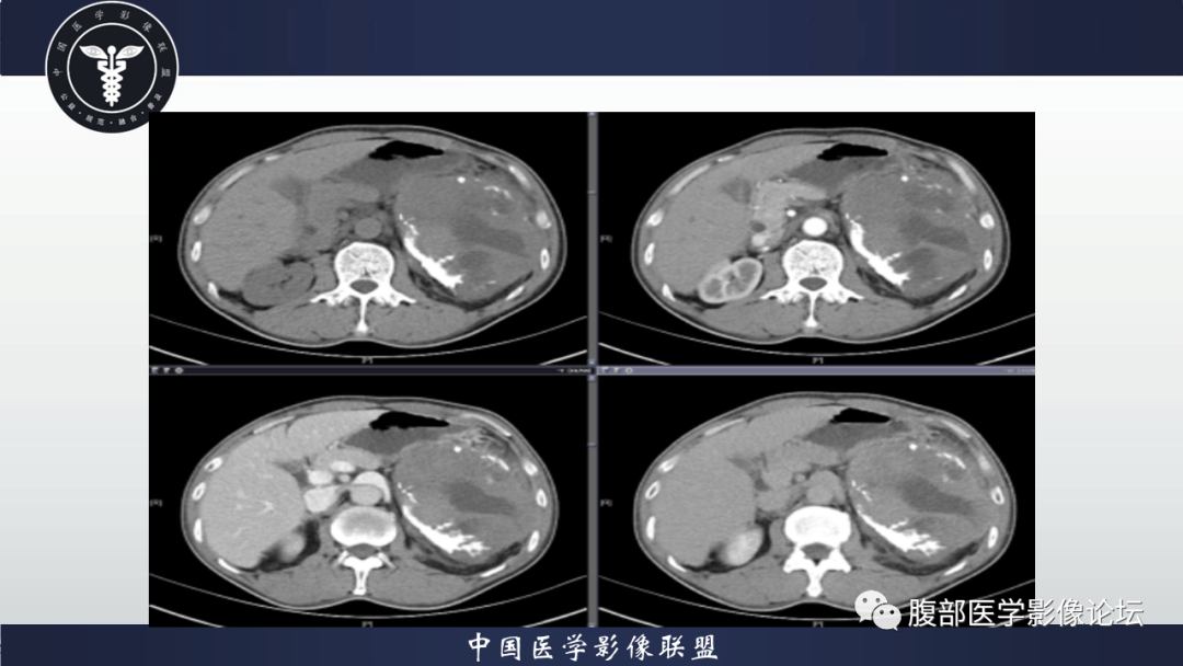 影像PPT - 【病例】腹腔低度恶性肌纤维母细胞肉瘤（LGMS）1例CT-12