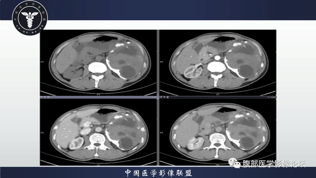 影像PPT - 【病例】腹腔低度恶性肌纤维母细胞肉瘤（LGMS）1例CT-13