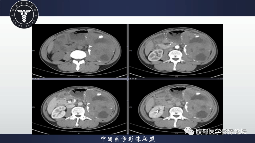 影像PPT - 【病例】腹腔低度恶性肌纤维母细胞肉瘤（LGMS）1例CT-14