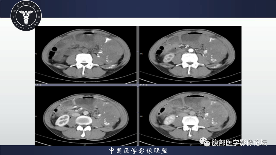 影像PPT - 【病例】腹腔低度恶性肌纤维母细胞肉瘤（LGMS）1例CT-15