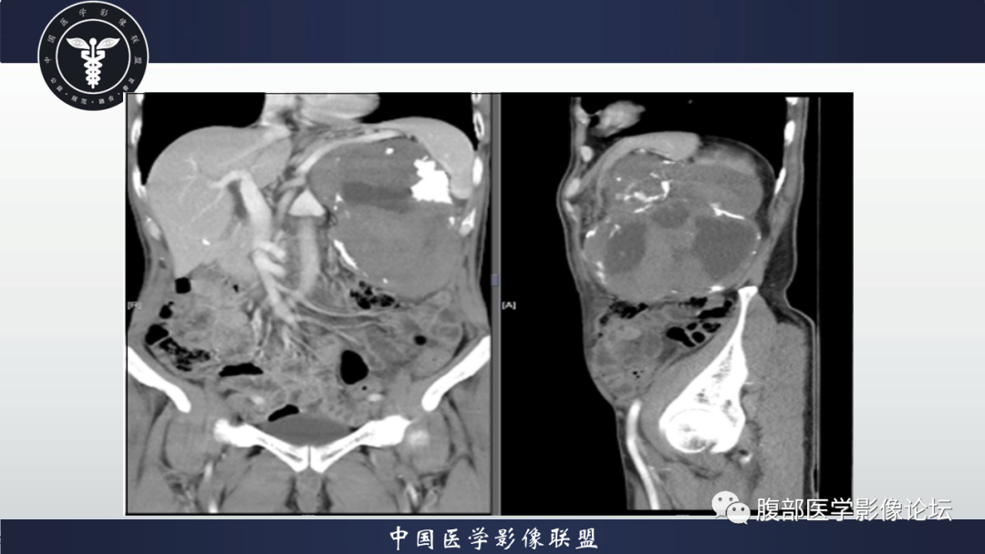 影像PPT - 【病例】腹腔低度恶性肌纤维母细胞肉瘤（LGMS）1例CT-16