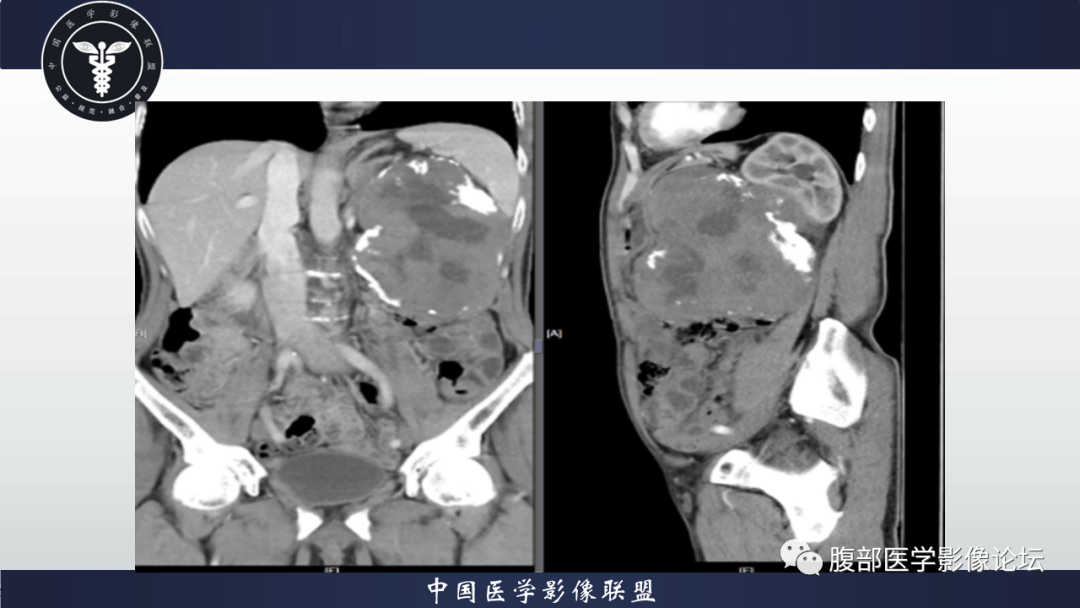 影像PPT - 【病例】腹腔低度恶性肌纤维母细胞肉瘤（LGMS）1例CT-17