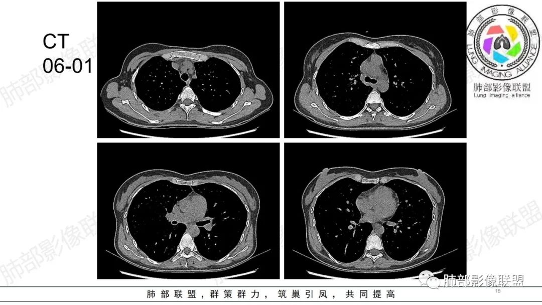 影像PPT - 【病例】肺部弥漫大B淋巴瘤病例思考及启示-15 影像PPT - 【病例】肺部弥漫大B淋巴瘤病例思考及启示-15
