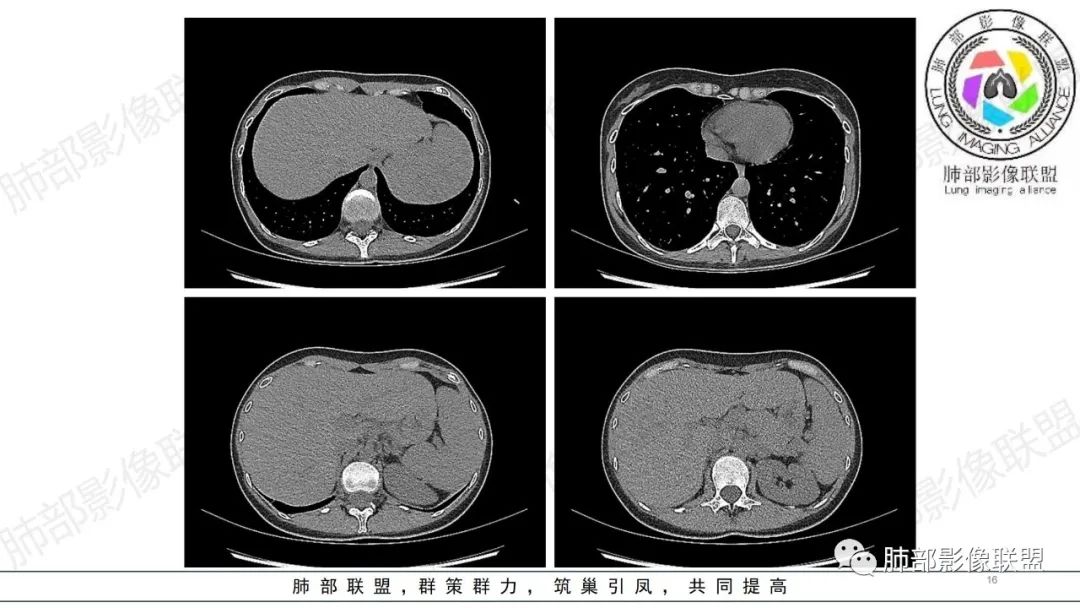 影像PPT - 【病例】肺部弥漫大B淋巴瘤病例思考及启示-16 影像PPT - 【病例】肺部弥漫大B淋巴瘤病例思考及启示-16