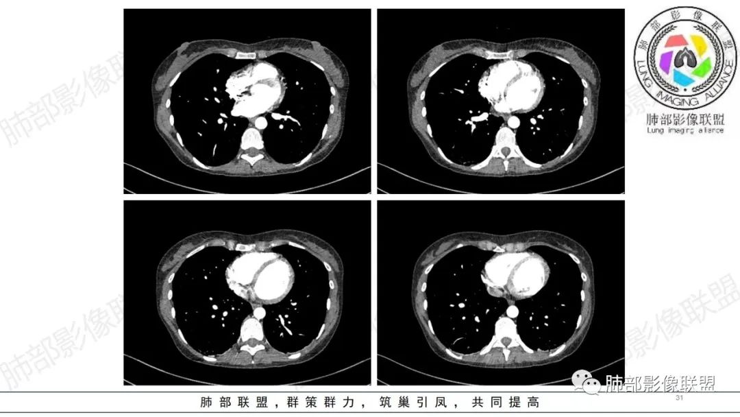 影像PPT - 【病例】肺部弥漫大B淋巴瘤病例思考及启示-31 影像PPT - 【病例】肺部弥漫大B淋巴瘤病例思考及启示-31