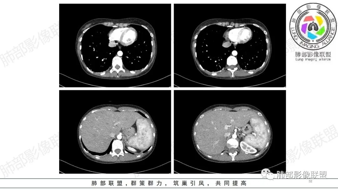 影像PPT - 【病例】肺部弥漫大B淋巴瘤病例思考及启示-32 影像PPT - 【病例】肺部弥漫大B淋巴瘤病例思考及启示-32