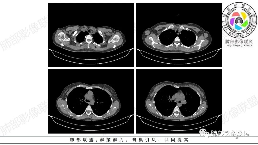 影像PPT - 【病例】肺部弥漫大B淋巴瘤病例思考及启示-47 影像PPT - 【病例】肺部弥漫大B淋巴瘤病例思考及启示-47