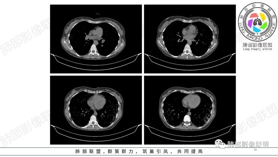 影像PPT - 【病例】肺部弥漫大B淋巴瘤病例思考及启示-48 影像PPT - 【病例】肺部弥漫大B淋巴瘤病例思考及启示-48