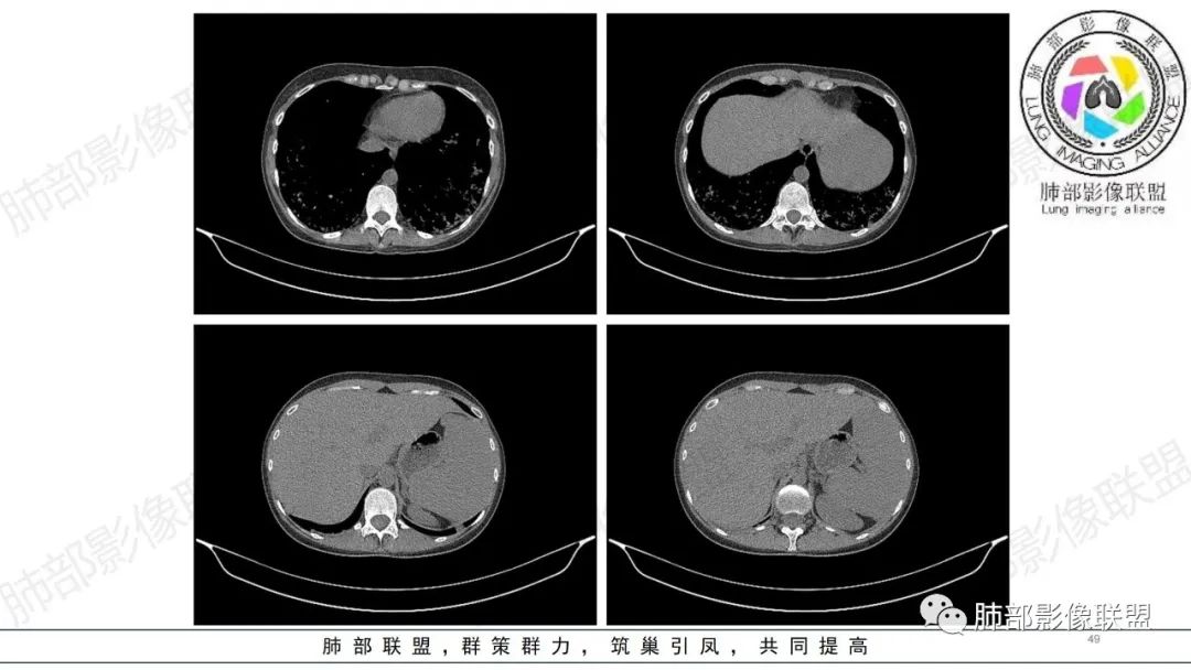 影像PPT - 【病例】肺部弥漫大B淋巴瘤病例思考及启示-49 影像PPT - 【病例】肺部弥漫大B淋巴瘤病例思考及启示-49