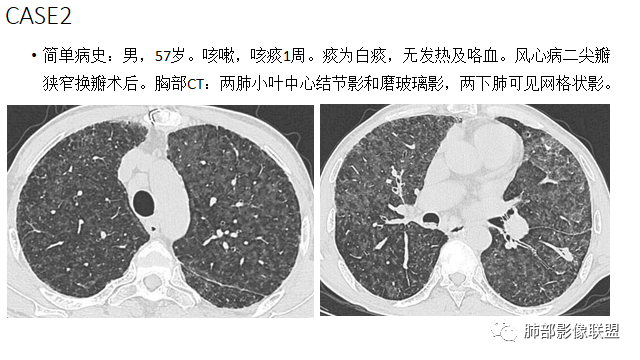 影像PPT - 【病例】肺部弥漫大B淋巴瘤病例思考及启示-54 影像PPT - 【病例】肺部弥漫大B淋巴瘤病例思考及启示-54