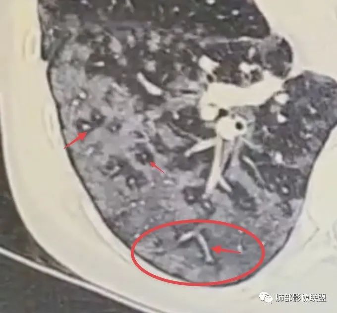 影像PPT - 【病例】肺部弥漫大B淋巴瘤病例思考及启示-67 影像PPT - 【病例】肺部弥漫大B淋巴瘤病例思考及启示-67