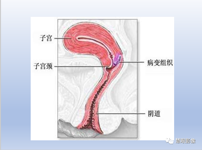 影像PPT - 【PPT】宫颈癌的MRI诊断与分期-3