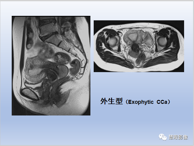 影像PPT - 【PPT】宫颈癌的MRI诊断与分期-12