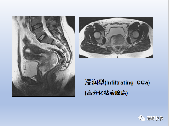 影像PPT - 【PPT】宫颈癌的MRI诊断与分期-13