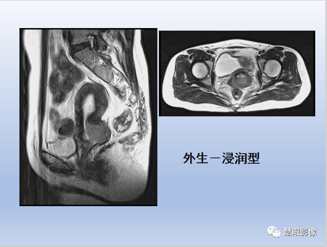 影像PPT - 【PPT】宫颈癌的MRI诊断与分期-14