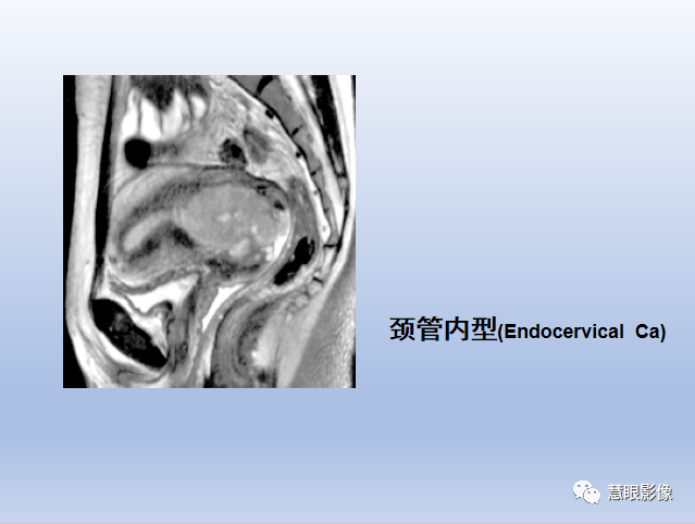 影像PPT - 【PPT】宫颈癌的MRI诊断与分期-15