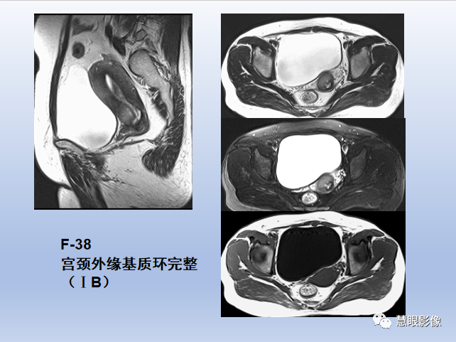 影像PPT - 【PPT】宫颈癌的MRI诊断与分期-23