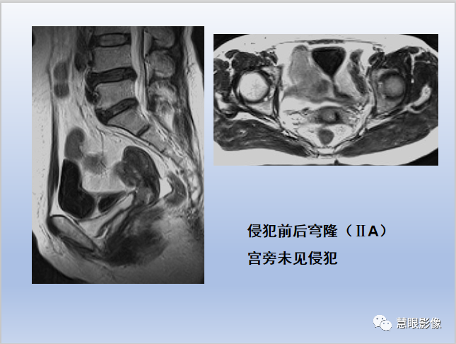 影像PPT - 【PPT】宫颈癌的MRI诊断与分期-24