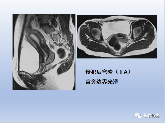 影像PPT - 【PPT】宫颈癌的MRI诊断与分期-25