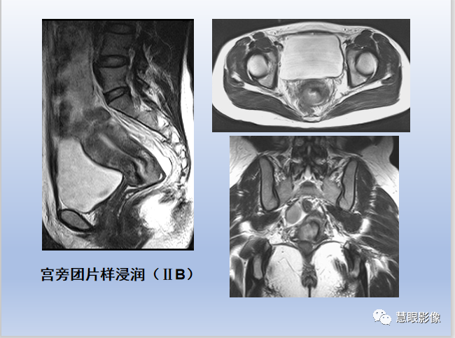 影像PPT - 【PPT】宫颈癌的MRI诊断与分期-26