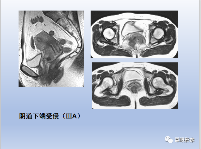 影像PPT - 【PPT】宫颈癌的MRI诊断与分期-27