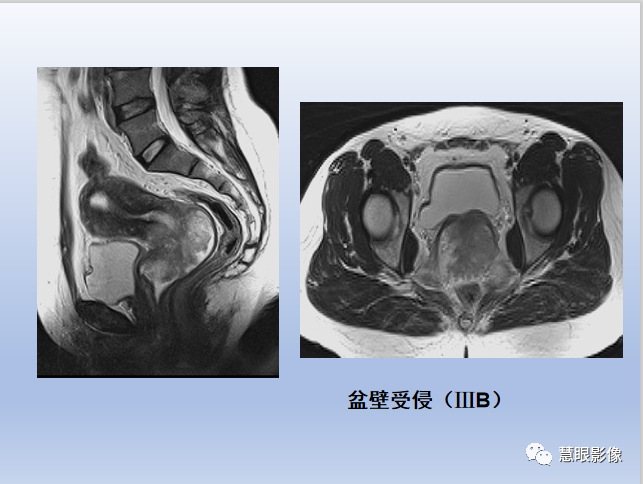 影像PPT - 【PPT】宫颈癌的MRI诊断与分期-28