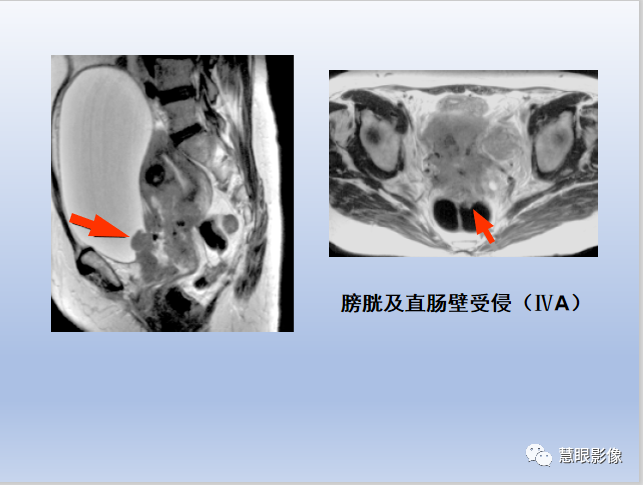 影像PPT - 【PPT】宫颈癌的MRI诊断与分期-30