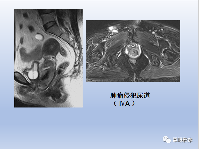 影像PPT - 【PPT】宫颈癌的MRI诊断与分期-31