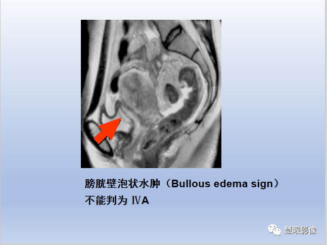 影像PPT - 【PPT】宫颈癌的MRI诊断与分期-32