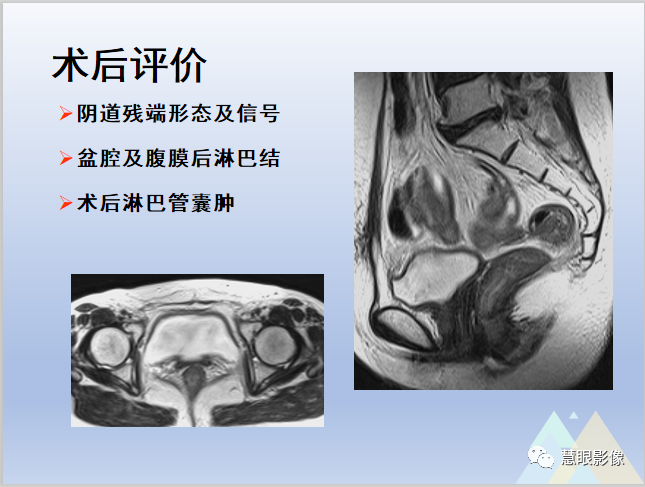影像PPT - 【PPT】宫颈癌的MRI诊断与分期-34