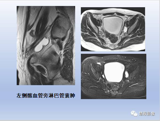影像PPT - 【PPT】宫颈癌的MRI诊断与分期-36